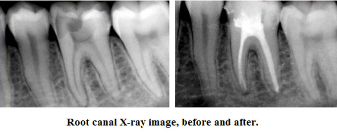 Root Canal Treatment in Mumbai